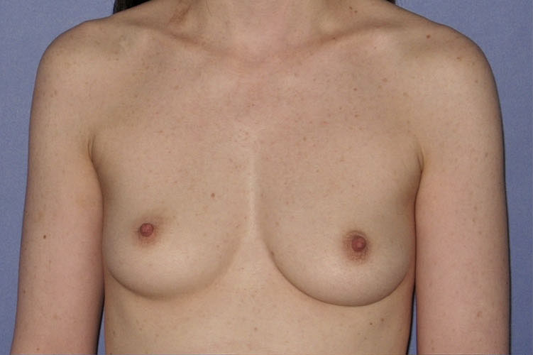 Patient Breast Augmentation Before 0