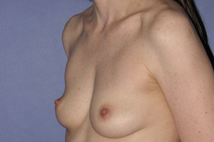 Patient Breast Augmentation Before 1