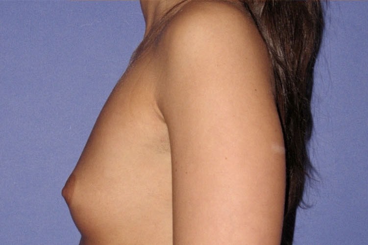 Patient Breast Augmentation Before 2