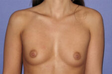 Patient Breast Augmentation Thumbnail Before 0