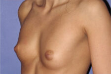 Patient Breast Augmentation Thumbnail Before 1