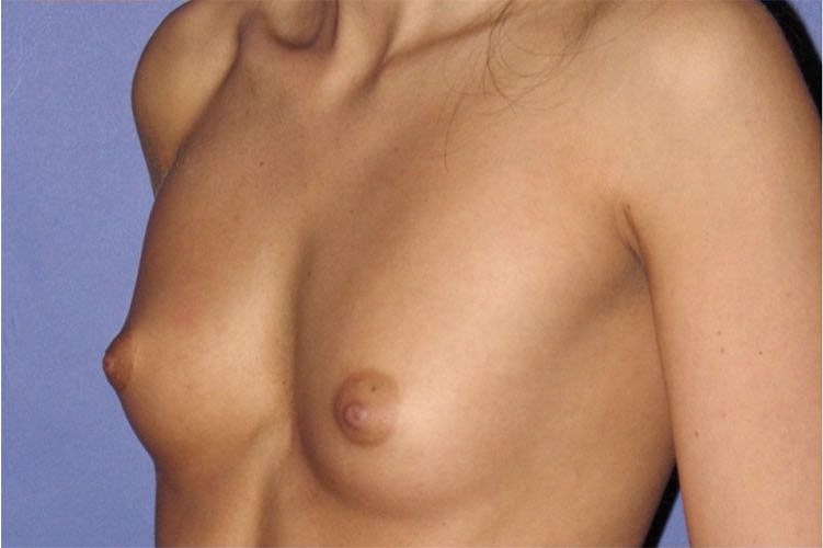 Patient Breast Augmentation Before 1
