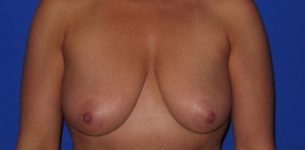 before breast augmentation front view case 1018