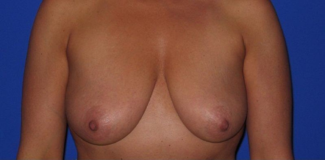 before breast augmentation front view case 1018