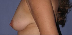 before breast augmentation side view case 1063