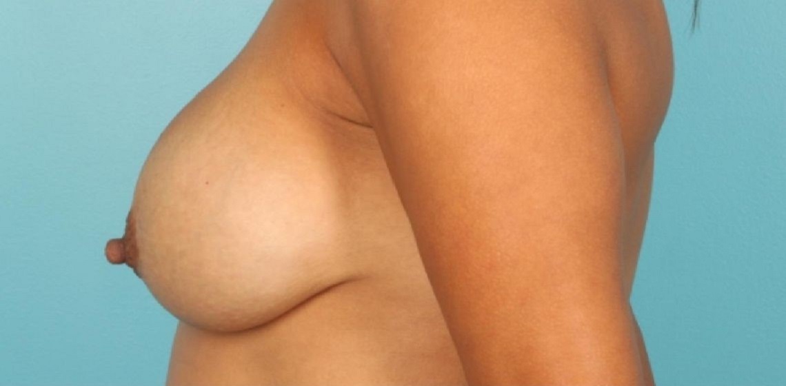 before breast augmentation side view case 1087