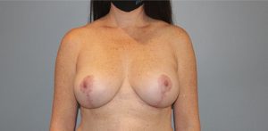 Patient Breast Augmentation Mastopexy After 0