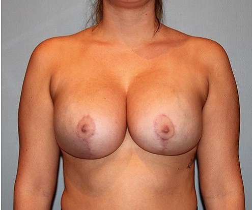 after breast augmentation front view case 1137