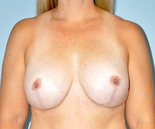 Patient Breast Augmentation Mastopexy Before 0