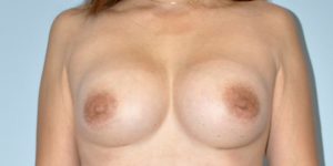 Patient Breast Implant Revision After 0