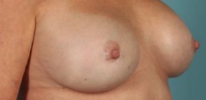 Patient Breast Implant Revision After 0