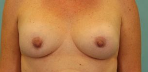 before breast implant revision front view case 865