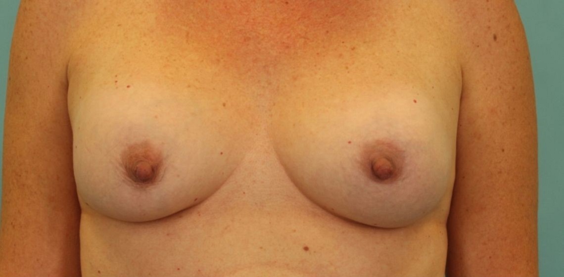 before breast implant revision front view case 865