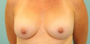 Patient Breast Implant Revision After 0