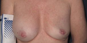 before breast implant revision front view case 880