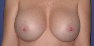 Patient Breast Implant Revision After 0