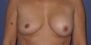 Patient Breast Implant Revision Before 0