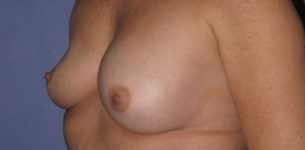 before breast implant revision angle view case 890