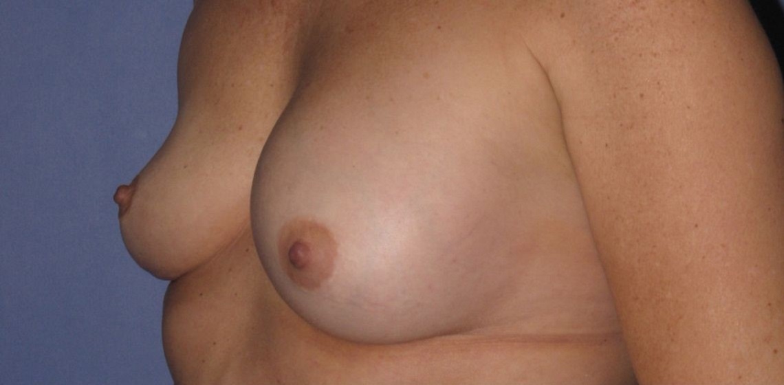 before breast implant revision angle view case 890