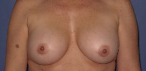 Patient Breast Implant Revision After 0