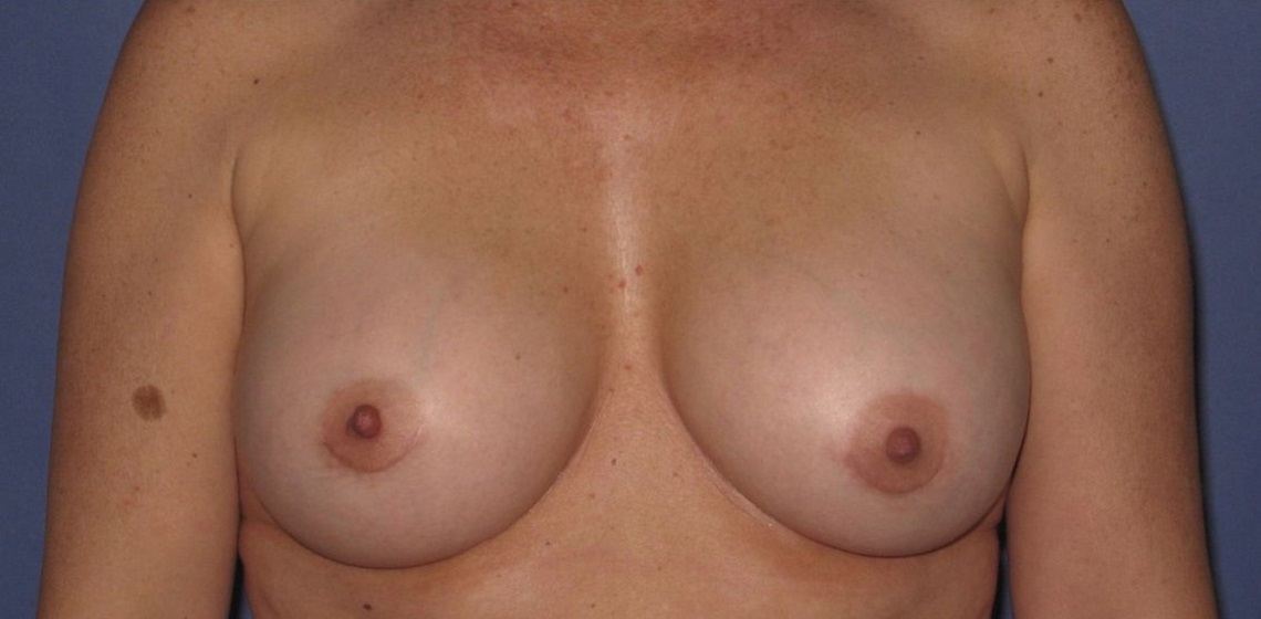 after breast implant revision front view case 890