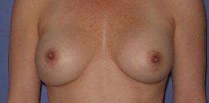 Patient Breast Implant Revision Thumbnail Before 0