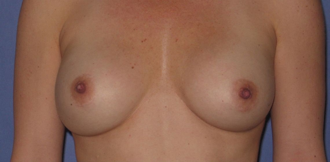 Patient Breast Implant Revision Before 0