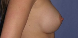 Patient Breast Implant Revision Thumbnail Before 1