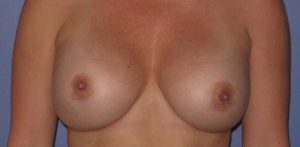 after breast implant revision front view case 909