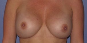 Patient Breast Implant Revision Thumbnail After 0