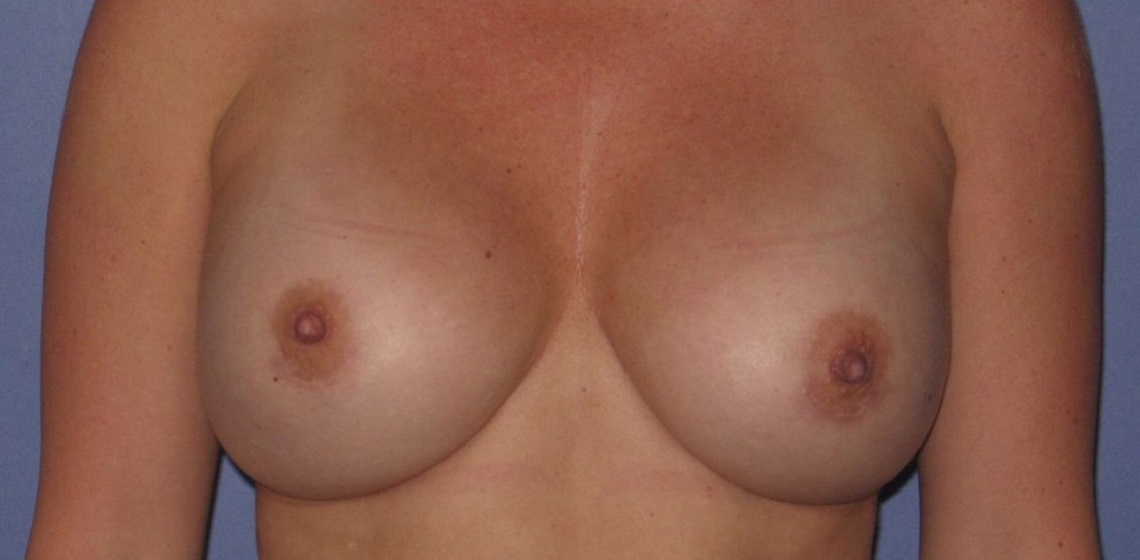 after breast implant revision front view case 909