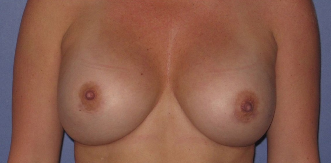 Patient Breast Implant Revision Before 0