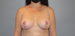 Patient Breast Implant Revision Thumbnail After 0