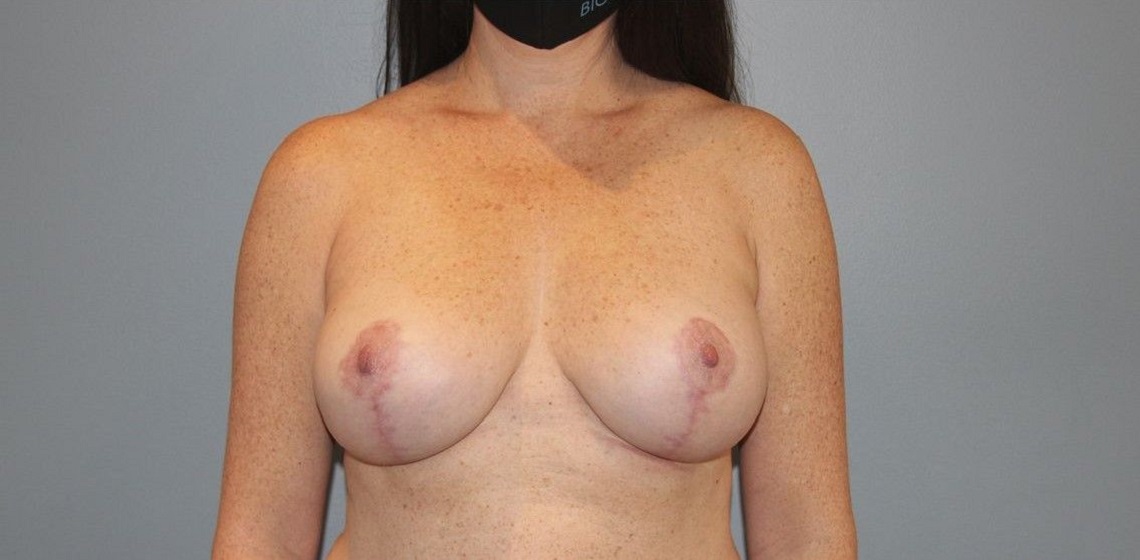 after breast augmentation front view case 965