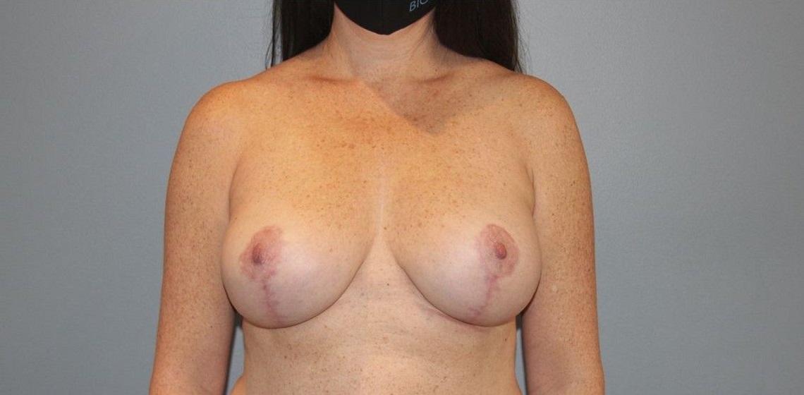 Patient Breast Implant Revision Before 0