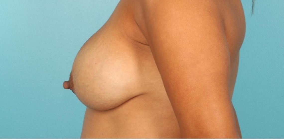 before Breast Lift diagonal view Case 1556