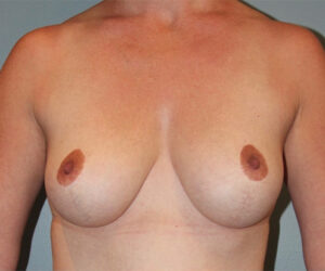 Patient Breast Lift After 0