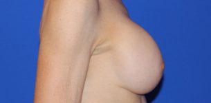 before breast lift right view of female patient 435 at Paydar Plastic Surgery