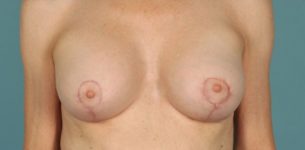 after breast lift front view of female patient 435 at Paydar Plastic Surgery