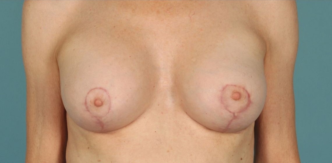 after breast lift front view of female patient 435 at Paydar Plastic Surgery