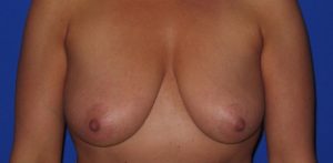 before breast lift front view of female patient 486 at Paydar Plastic Surgery