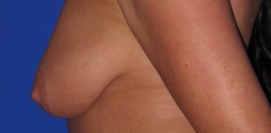 Patient Breast Lift Thumbnail Before 2