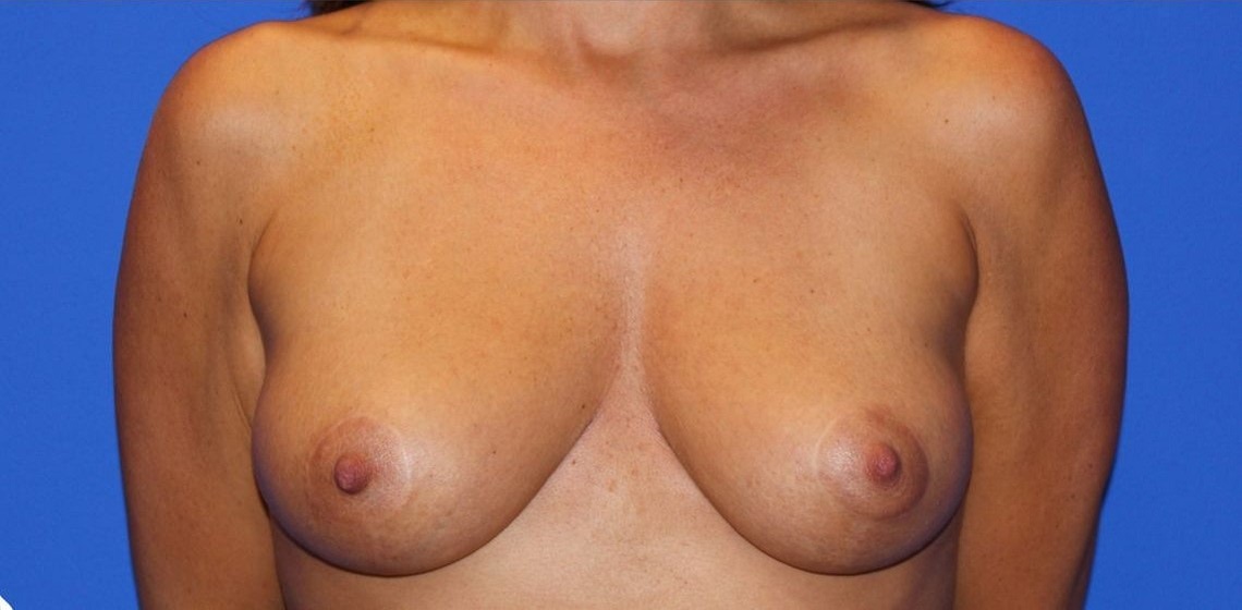 after breast lift front view of female patient 486 at Paydar Plastic Surgery