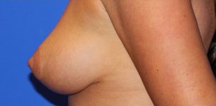 Patient Breast Lift Thumbnail After 2