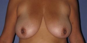 Patient Breast Lift Before 0