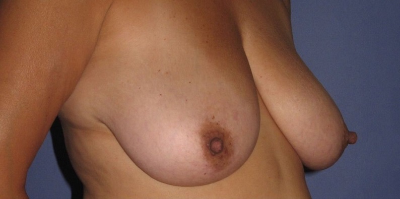 before breast lift right angle view of female patient 513 at Paydar Plastic Surgery
