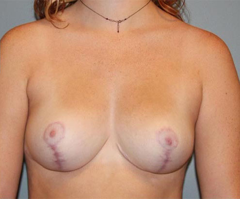 Patient Breast Lift Before 0