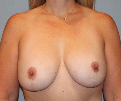 Patient Breast Lift Before 0