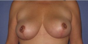 Patient Breast Lift After 0