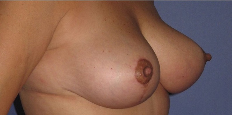 after breast lift right angle view of female patient 513 at Paydar Plastic Surgery